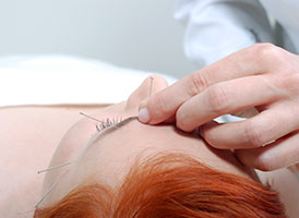 Frau wird eine Akupunkturnadel auf die Stirn gesetzt