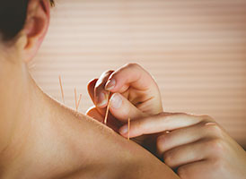 Frau werden Akupunkturnadeln in den Nacken gesetzt